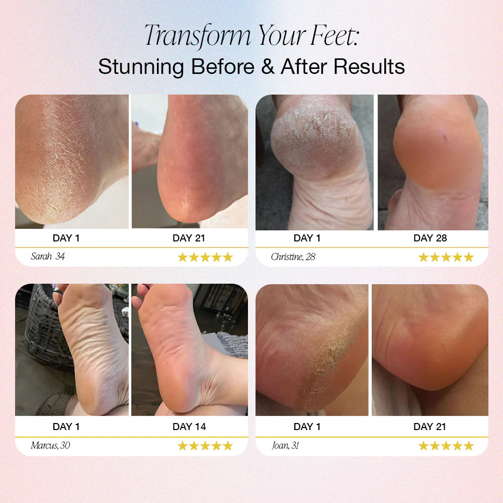 Auna® – Electric Foot Callus Remover