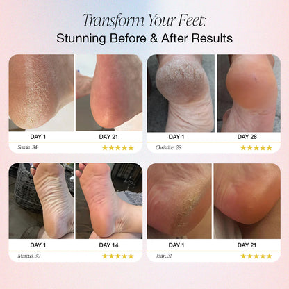 Auna® – Electric Foot Callus Remover